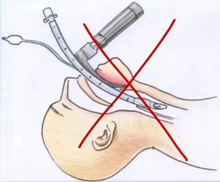 2术中:微创"无管"技术,包括无气管插管全麻,无尿管,无胸腔引流管等;1.