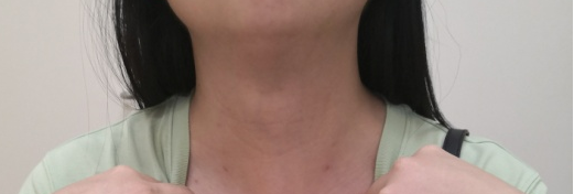 甲状腺图片2.png