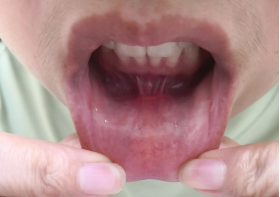 甲状腺图片3.png